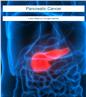 Pancreatic Cancer